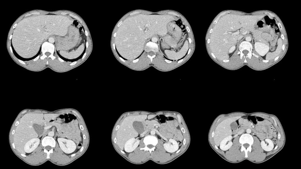 Tomografía de Abdomen