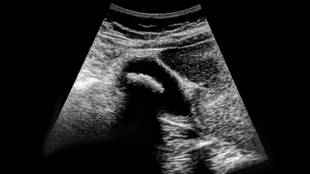 ultrasonido de vesícula