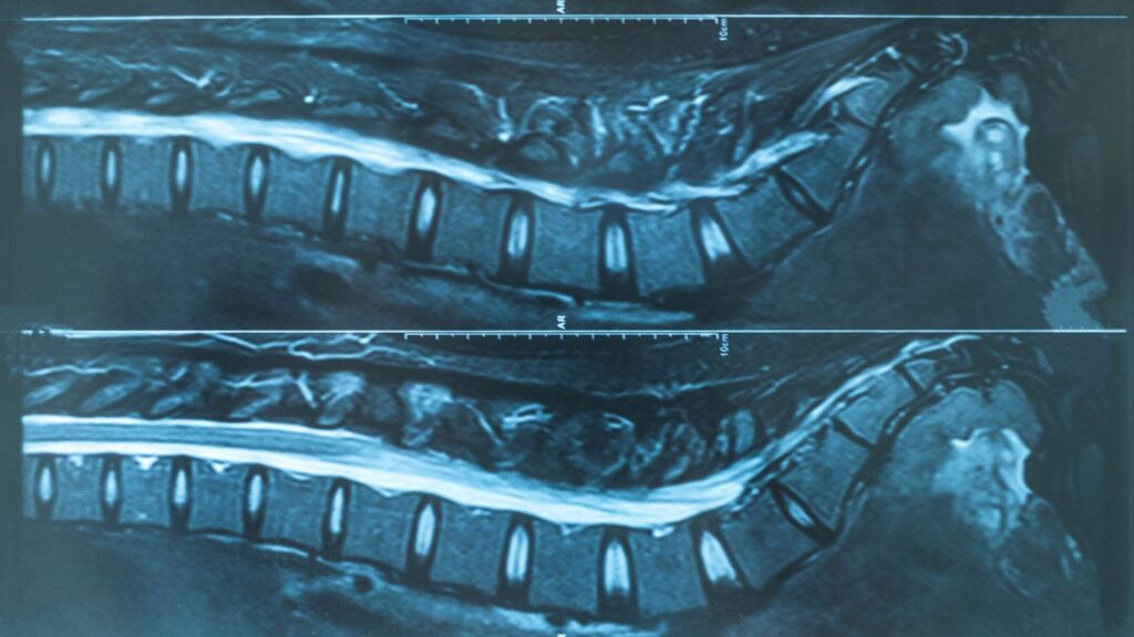 Tomografía Lumbosacra