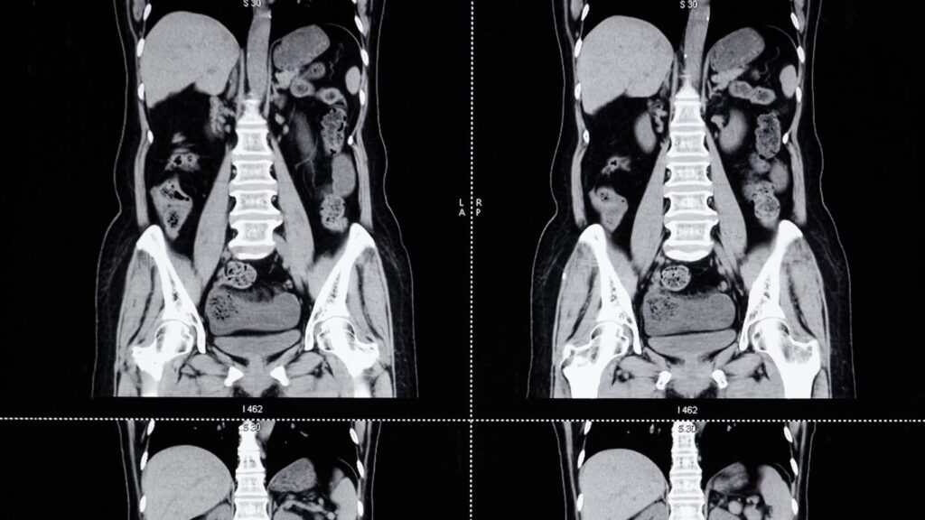 Tomografía Simple de Abdomen