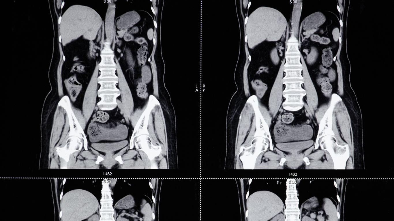 Tomografía Simple de Abdomen