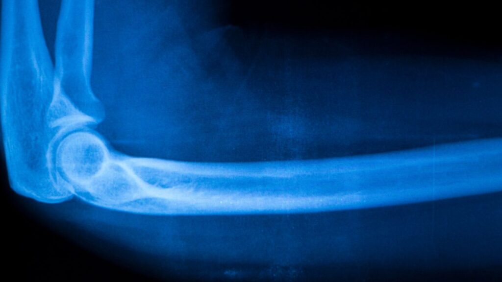 Tomografía del Brazo