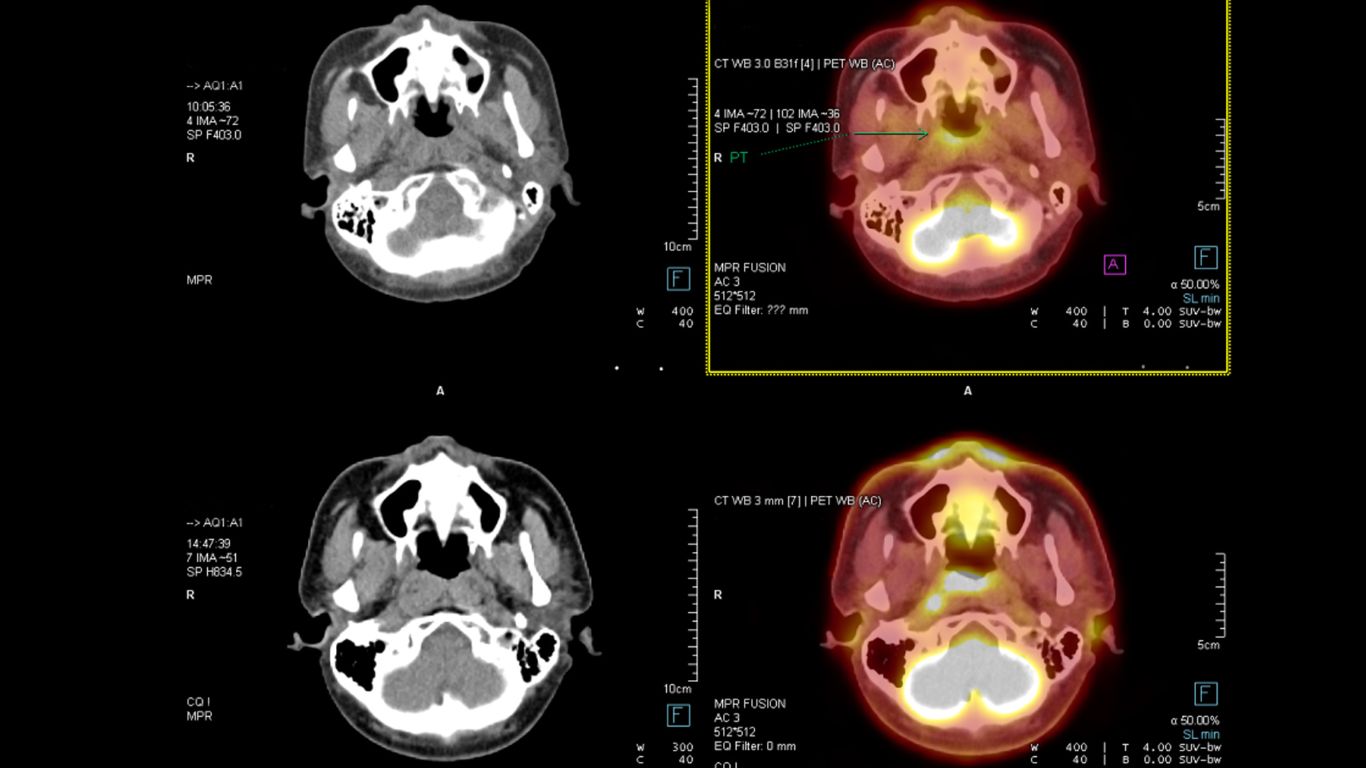 Tomografía para Detectar Cáncer